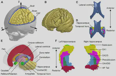 Finite element representation of ventricles, hippocampus, and temporal horn.