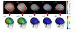 Local and Global Effects of Inertial Force Components Producing Brain Strain During Head Impacts